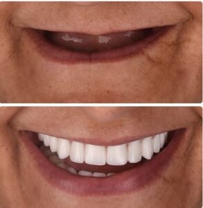 implant-beforeafter.jpg
