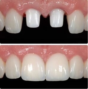 implant-beforeafter2.jpg
