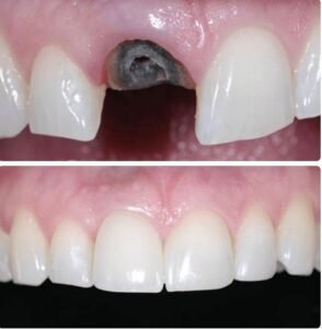 implant-beforeafter4.jpg