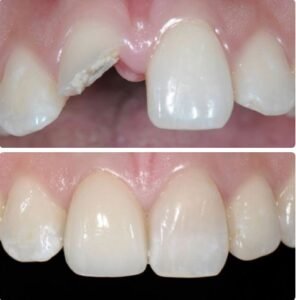 implant-beforeafter5.jpg