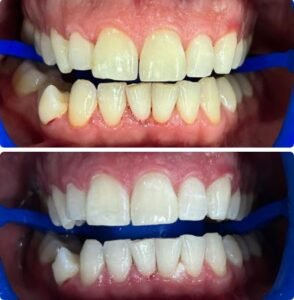 teeth-whiting1.jpg