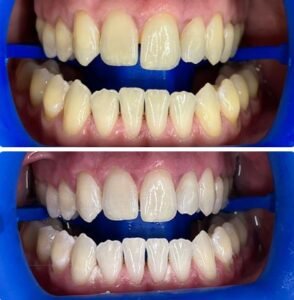 teeth-whiting2.jpg