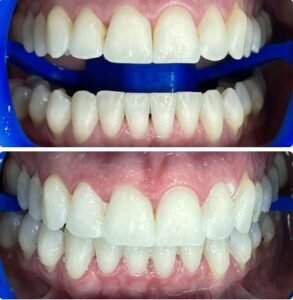 teeth-whiting3.jpg
