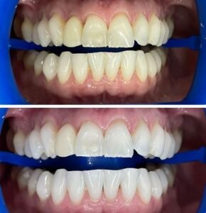 teeth-whiting4.jpg