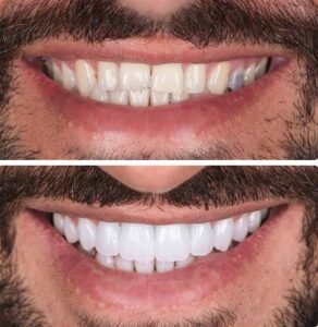 veneers-beforeafter.jpg