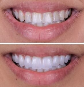 veneers-beforeafter3.jpg