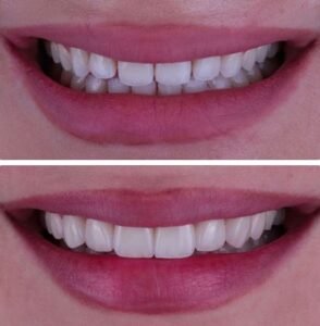 veneers-beforeafter5.jpg