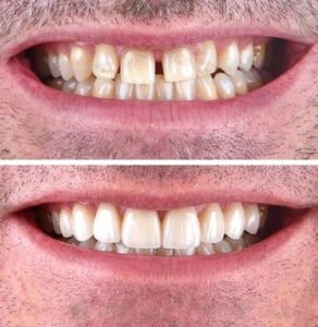 veneers-beforeafter6.jpg