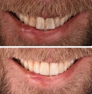 veneers-beforeafter7.jpg