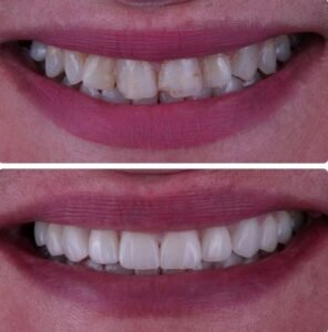 veneers-beforeafter8.jpg