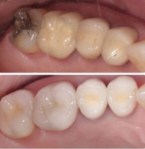 crown before&after3