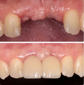 implant before&after1