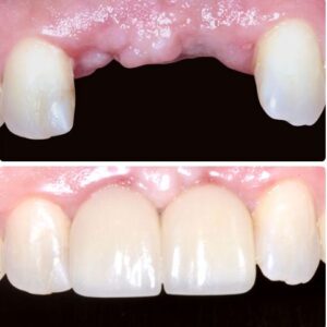 implant before&after3