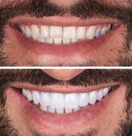 veneers before&after
