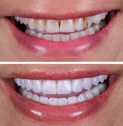 veneers before&after2