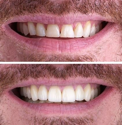 veneers before&after4