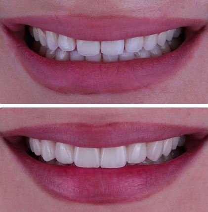 veneers before&after5