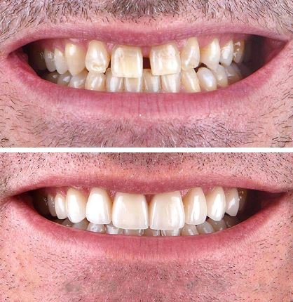 veneers before&after6