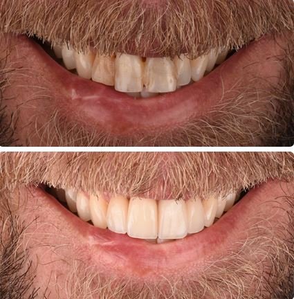 veneers before&after7