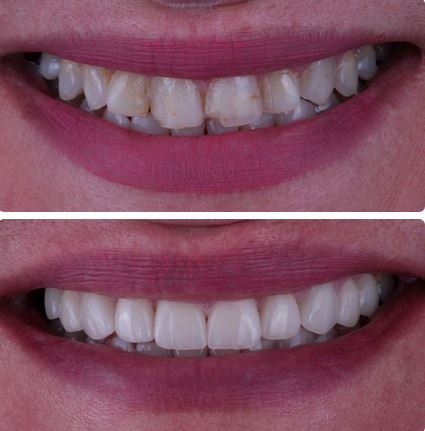 veneers before&after8