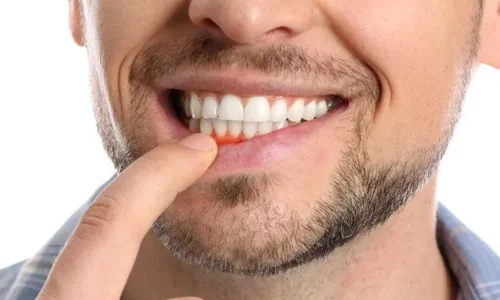 Gingivitis-Treatment-680×454 Gingivitis-Treatment-680x454