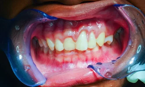 Periodontal-Therapy-680×454 Periodontal-Therapy-680x454