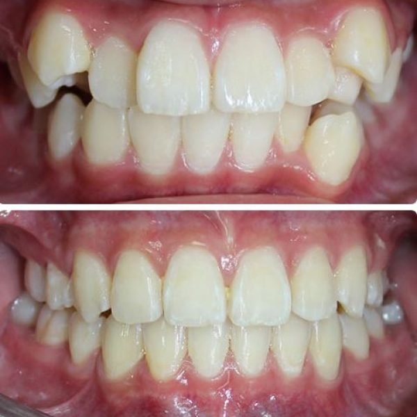 before&after1