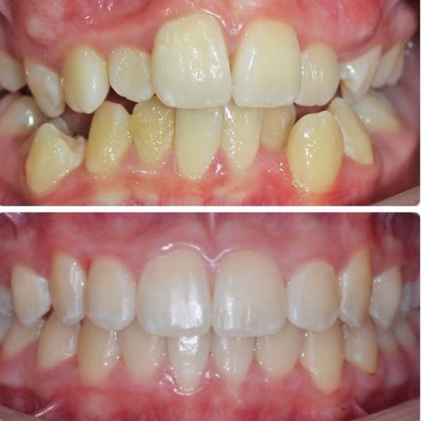 before&after2