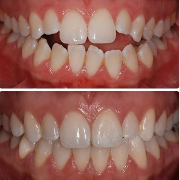 before&after3