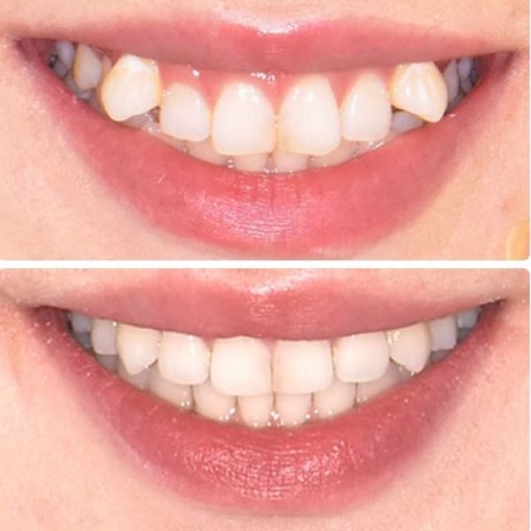 before&after4