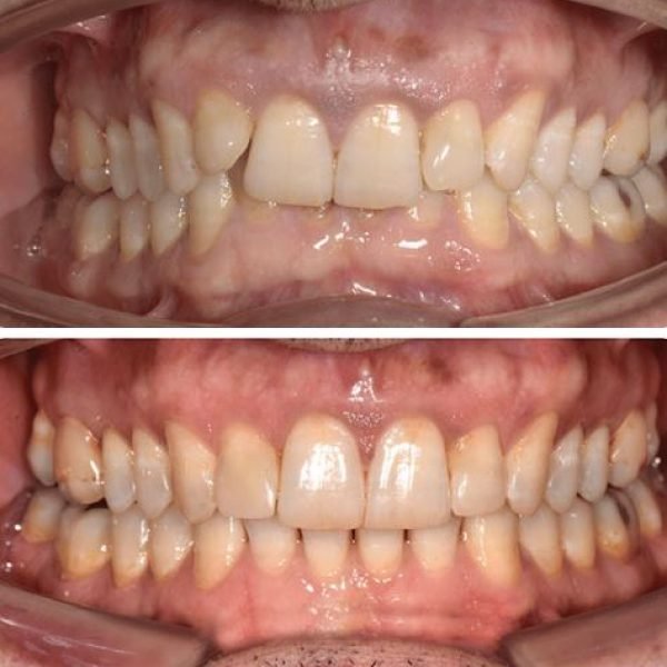 before&after5