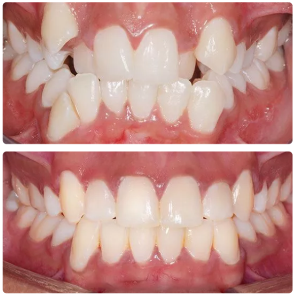 beforeafterbraces
