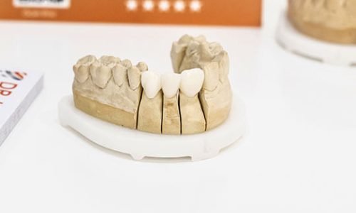 crowns-for-cosmetic-dentistry-smile-design